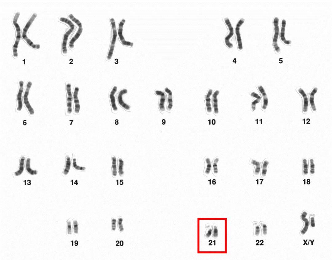 کاریوتایپ و کروموزوم 21 / Chromosome