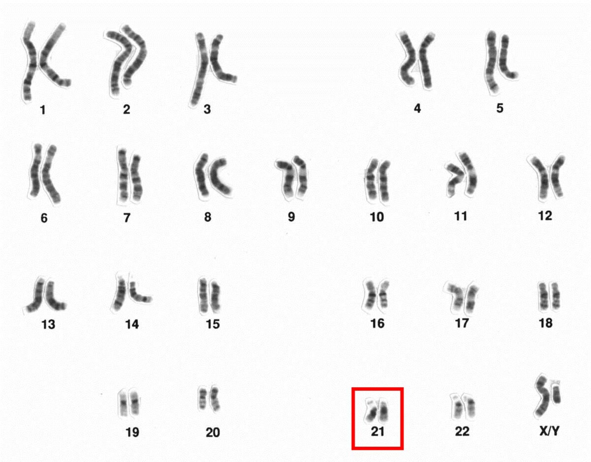 کاریوتایپ و کروموزوم 21 / Chromosome