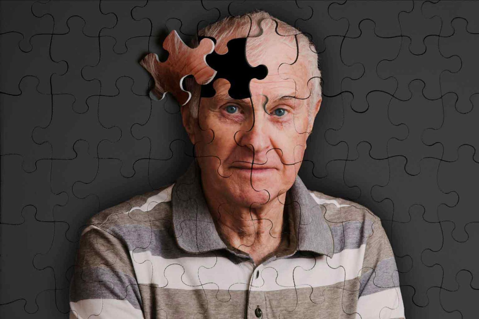 آلزایمر /  Alzheimer