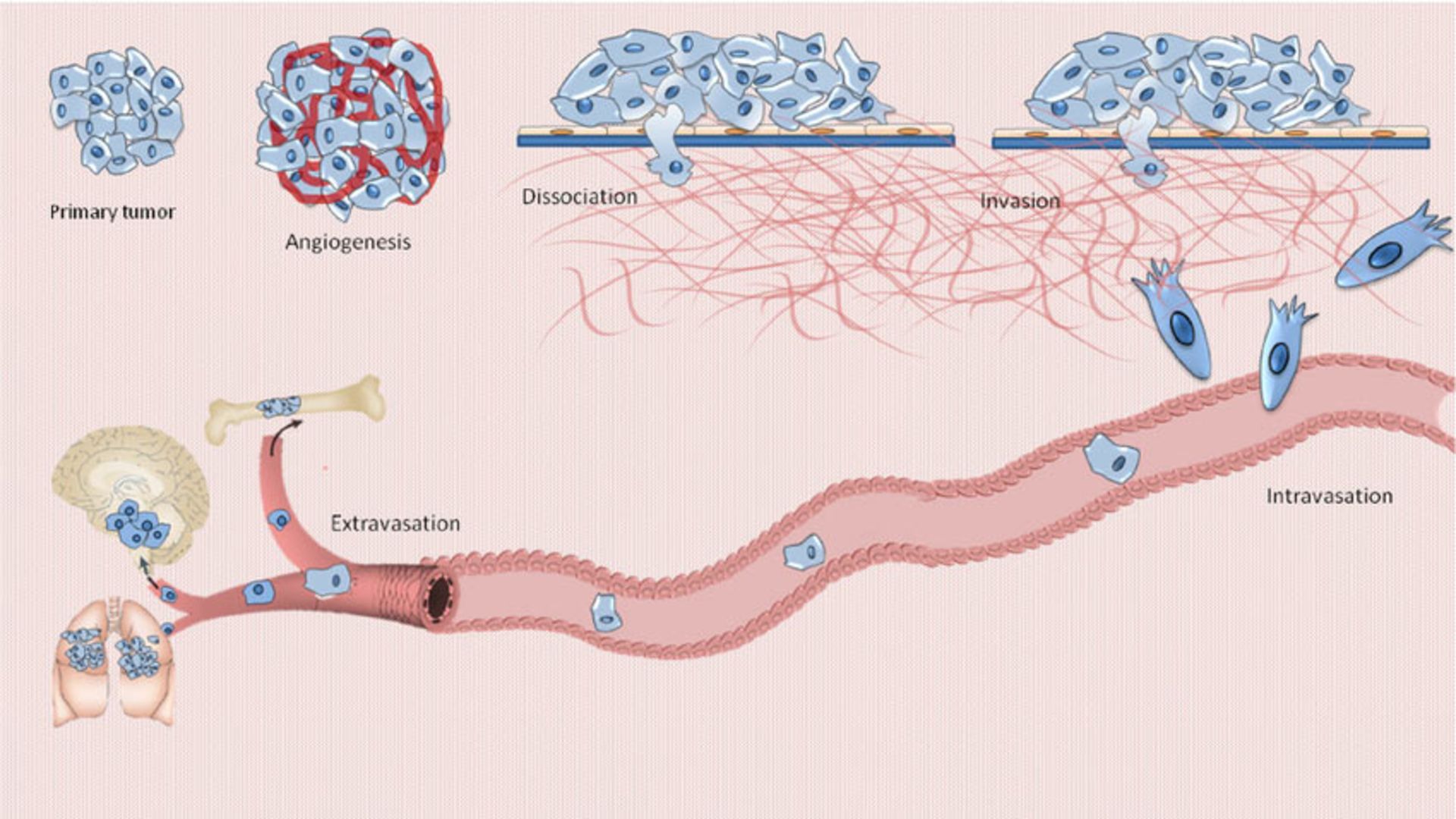 متاستاز / Metastasis