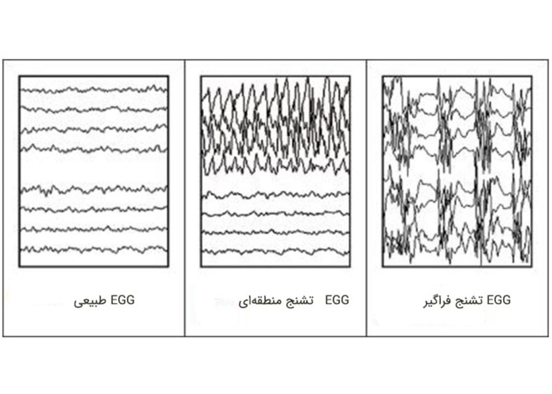 نوار مغزی 