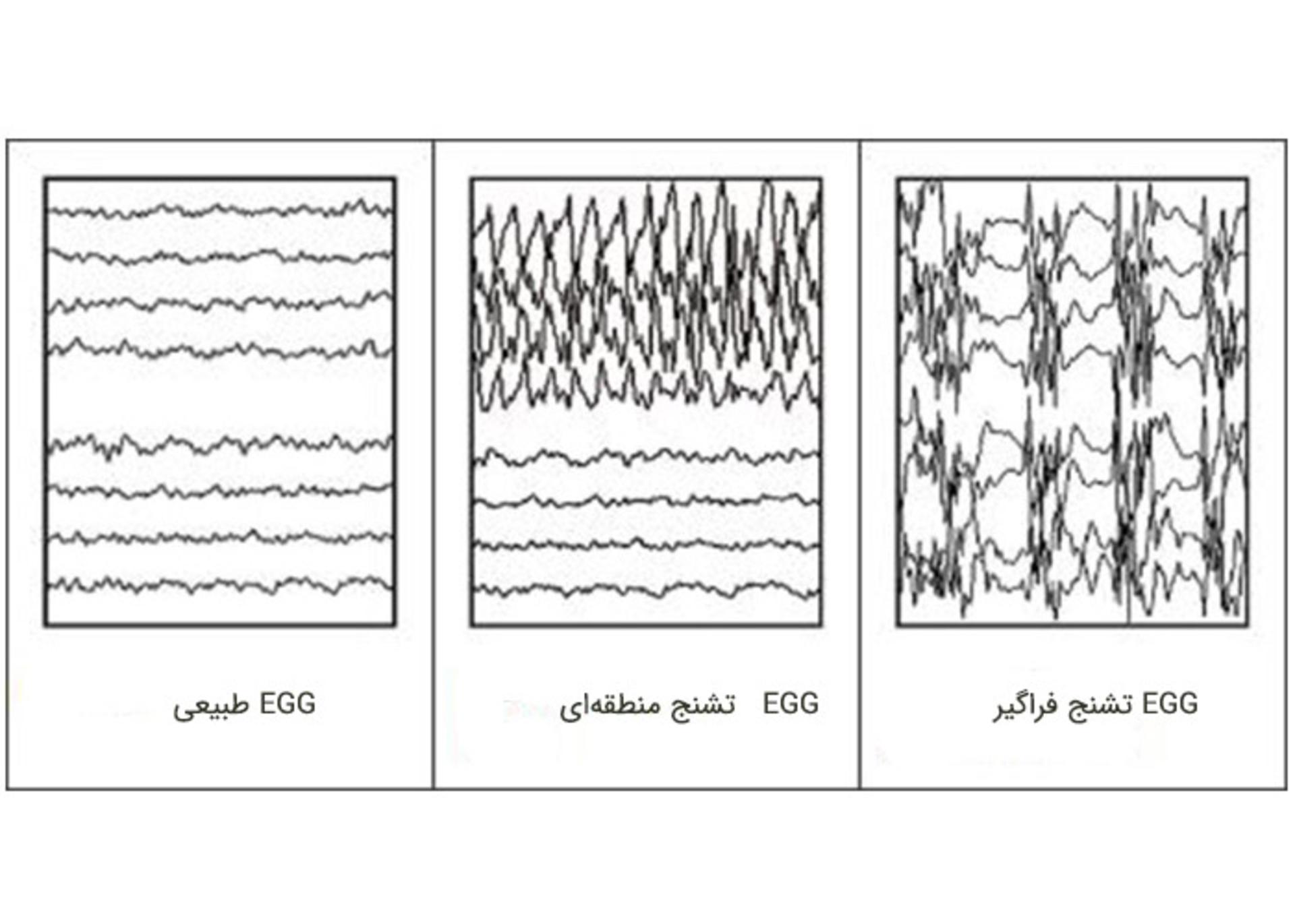 نوار مغزی 