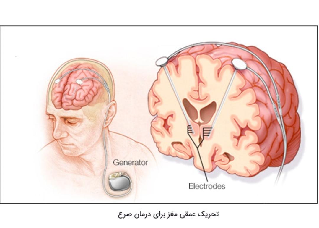 تحریک عمقی مغز