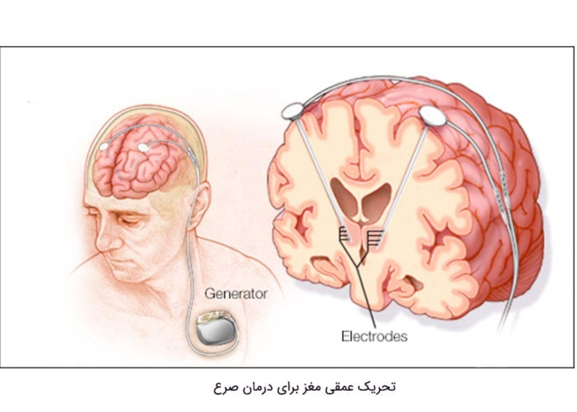 تحریک عمقی مغز