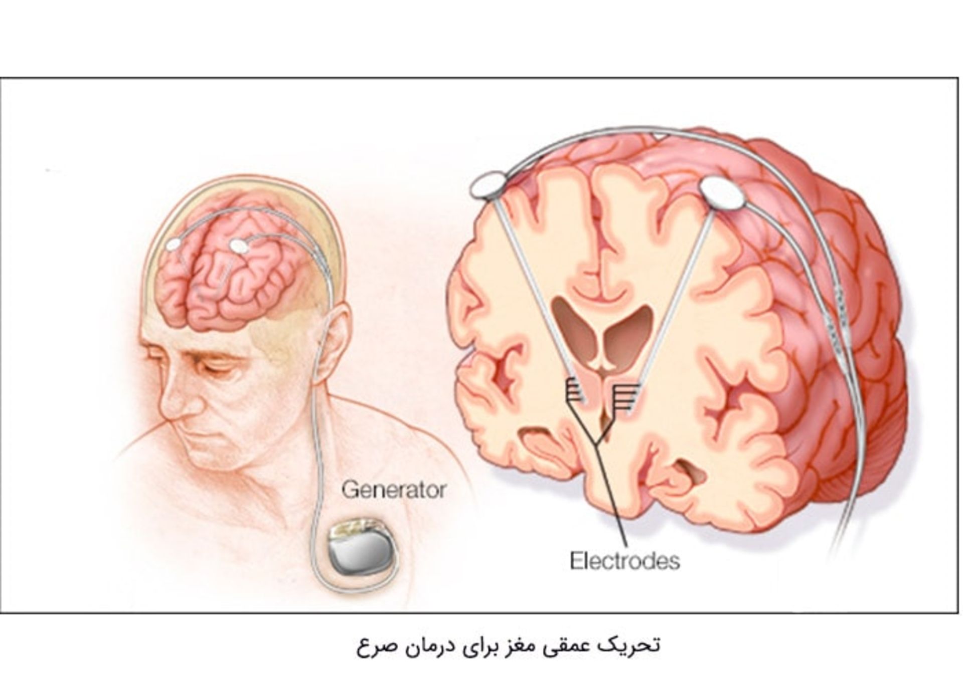 تحریک عمقی مغز