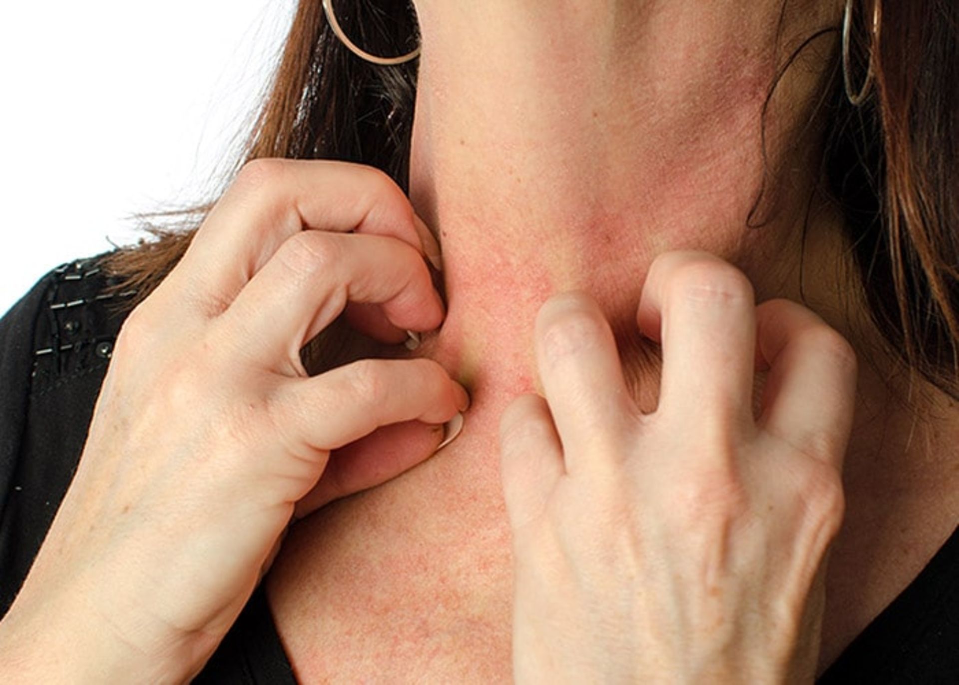 علایم آلرژی