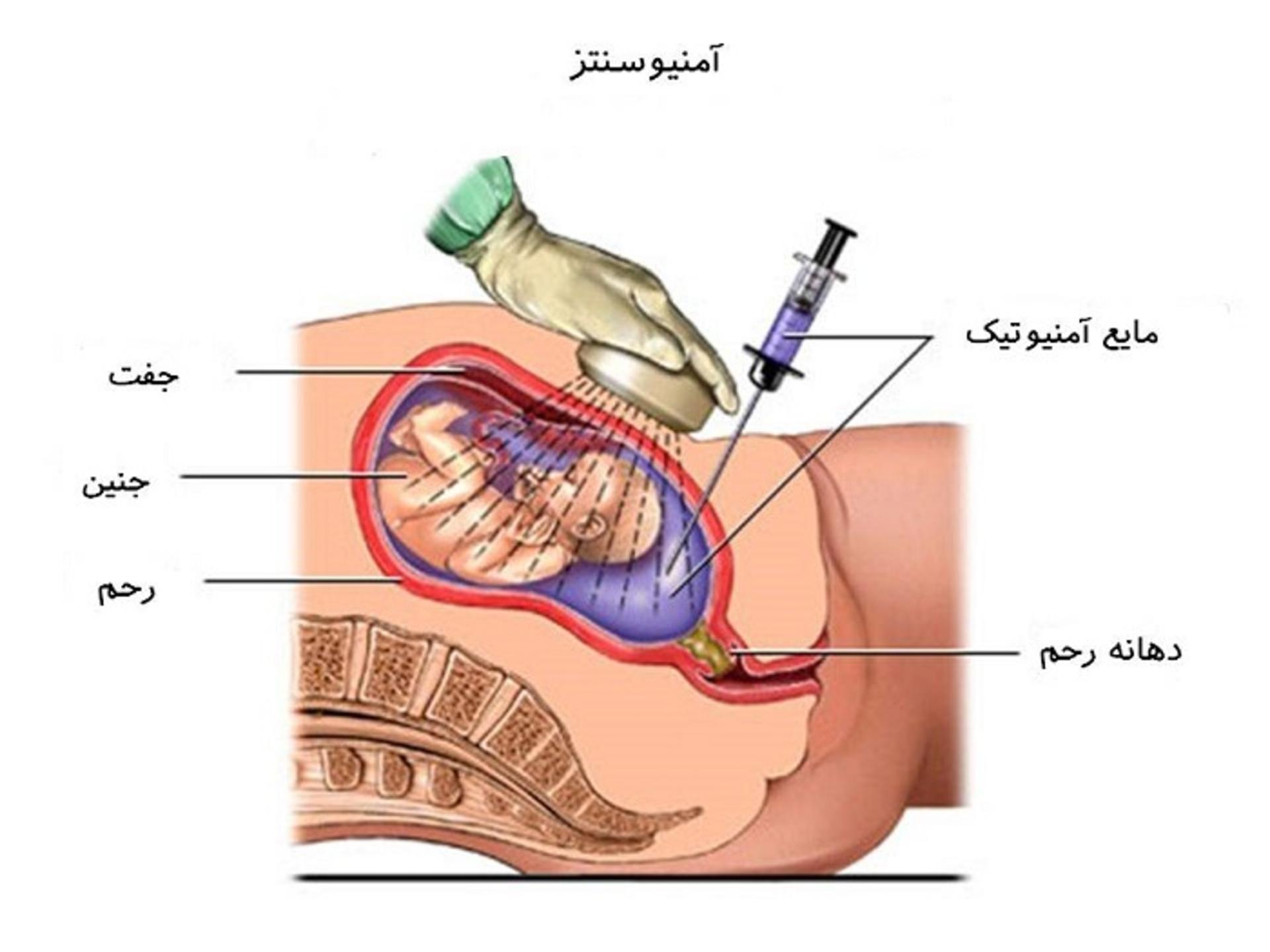  آمنیوسنتز