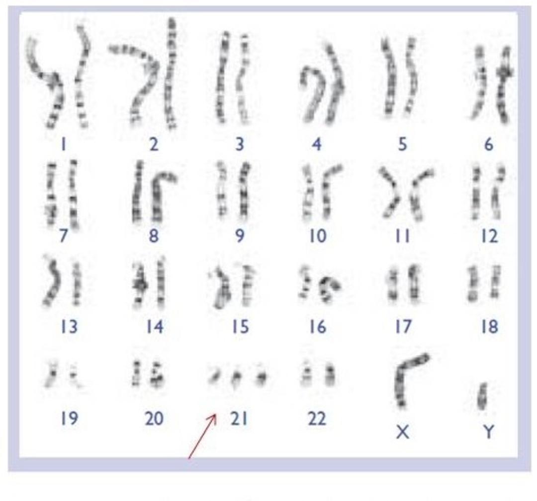 سندرم داون-مرد