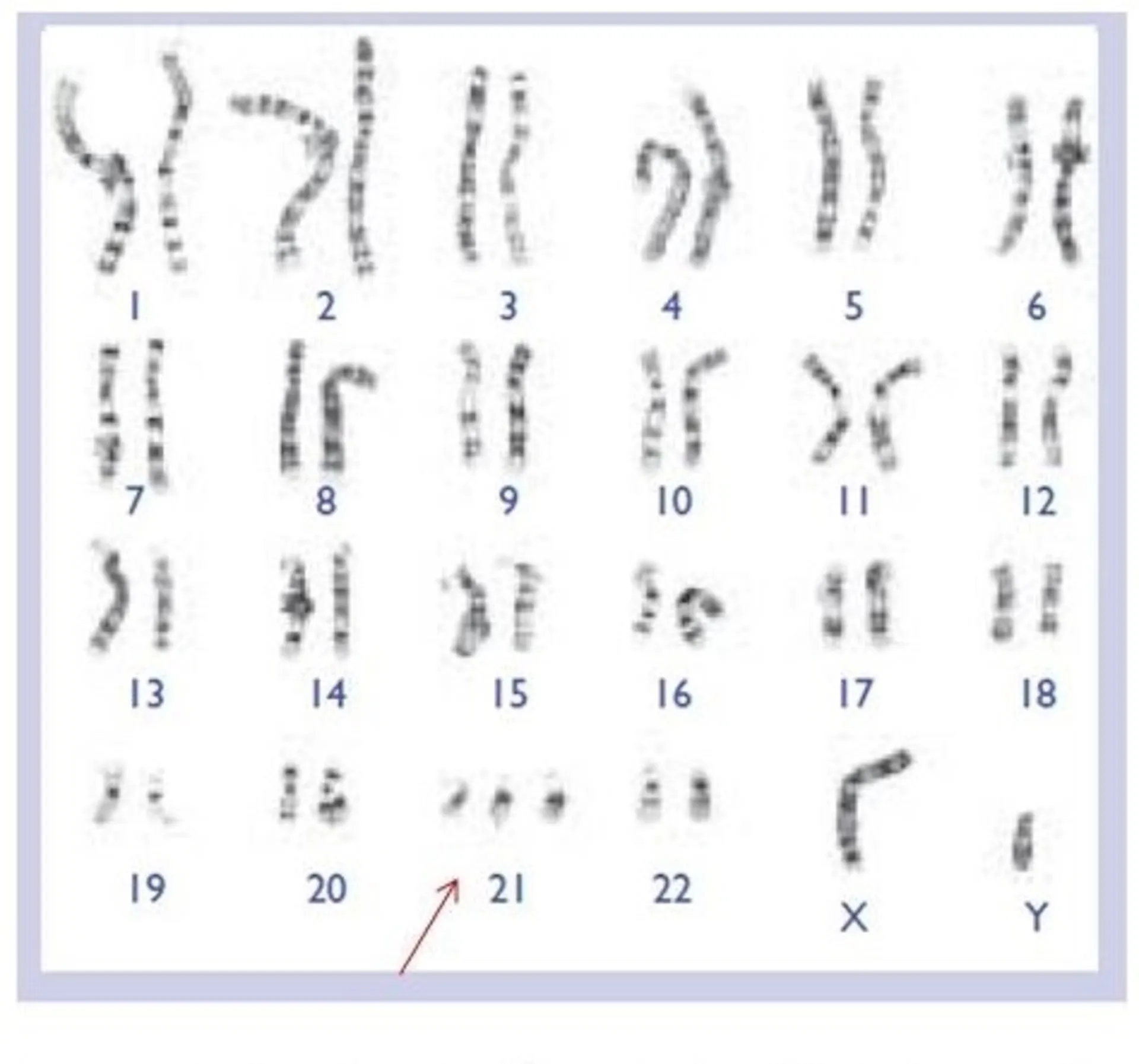سندرم داون-مرد