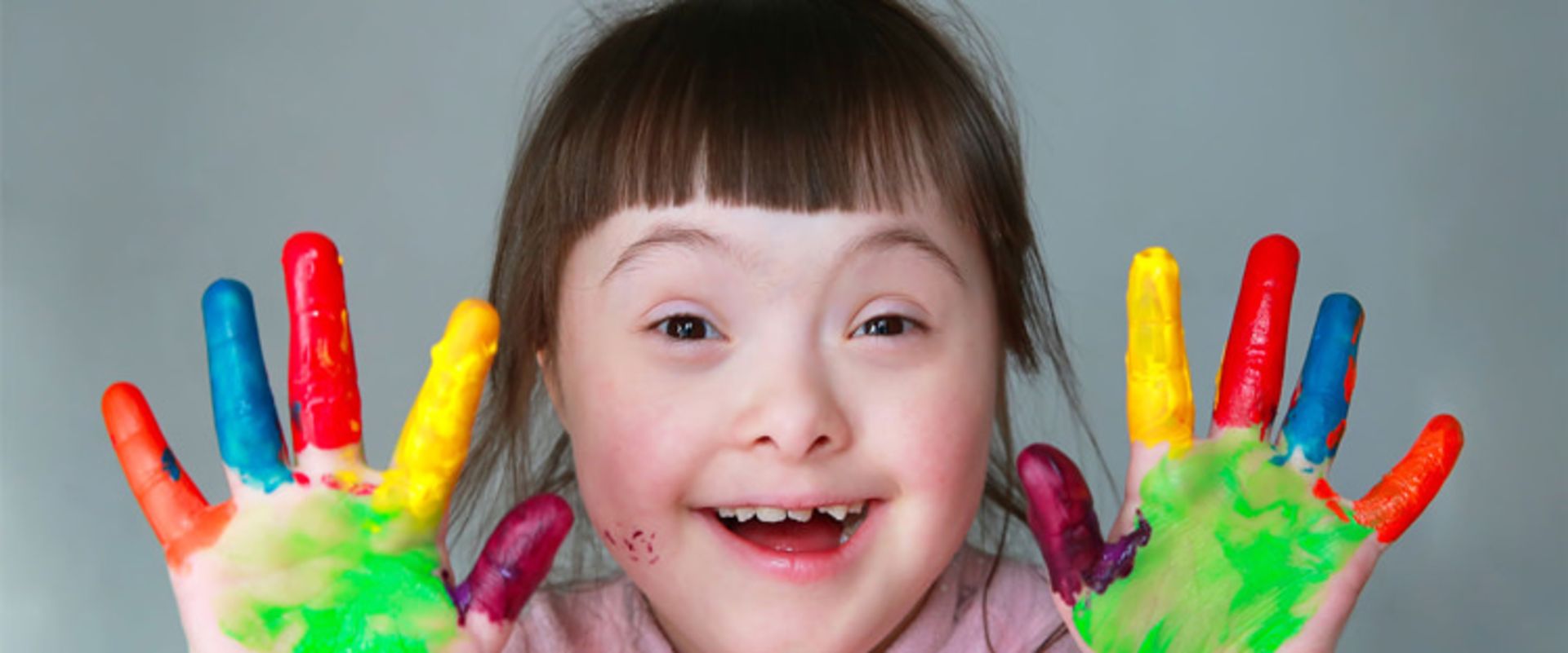 سندروم داون