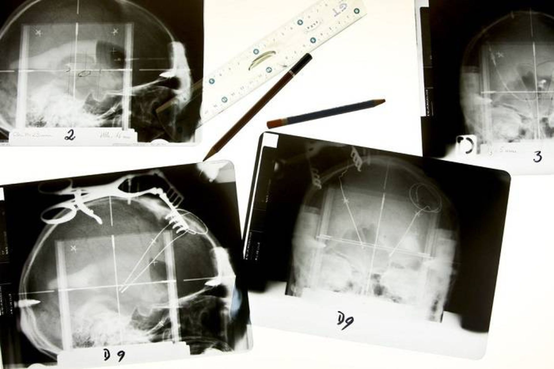 کاشت الکترود در مغز