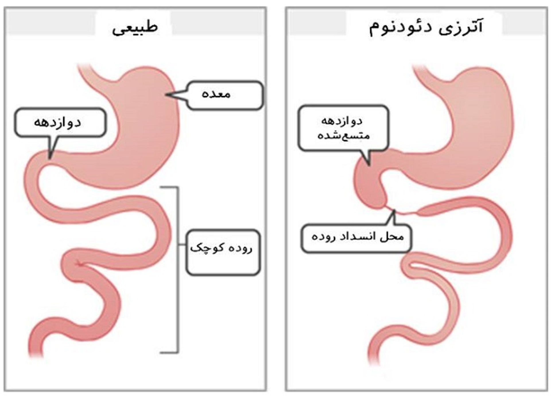 انسداد روده