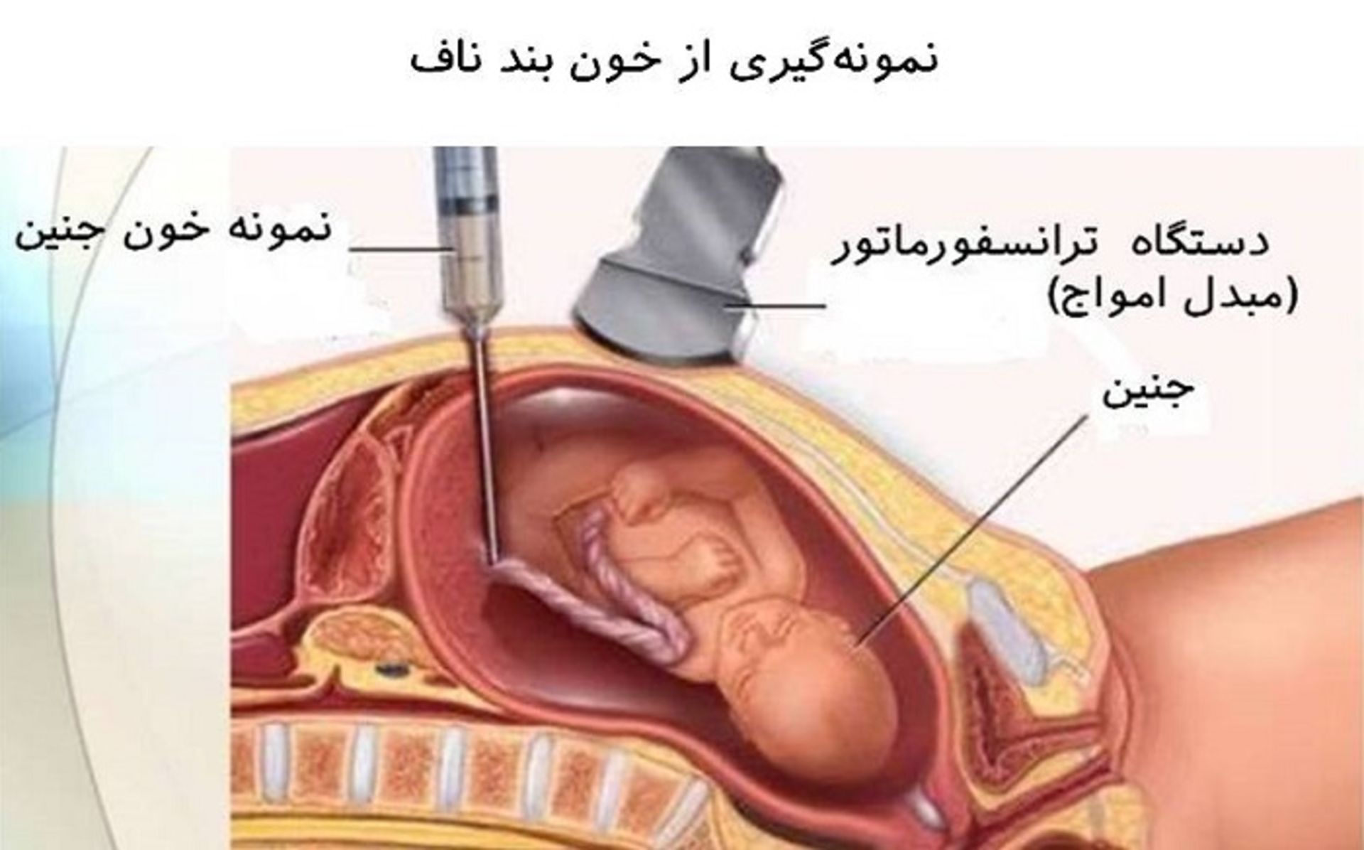 نمونه گیری از خون بند ناف