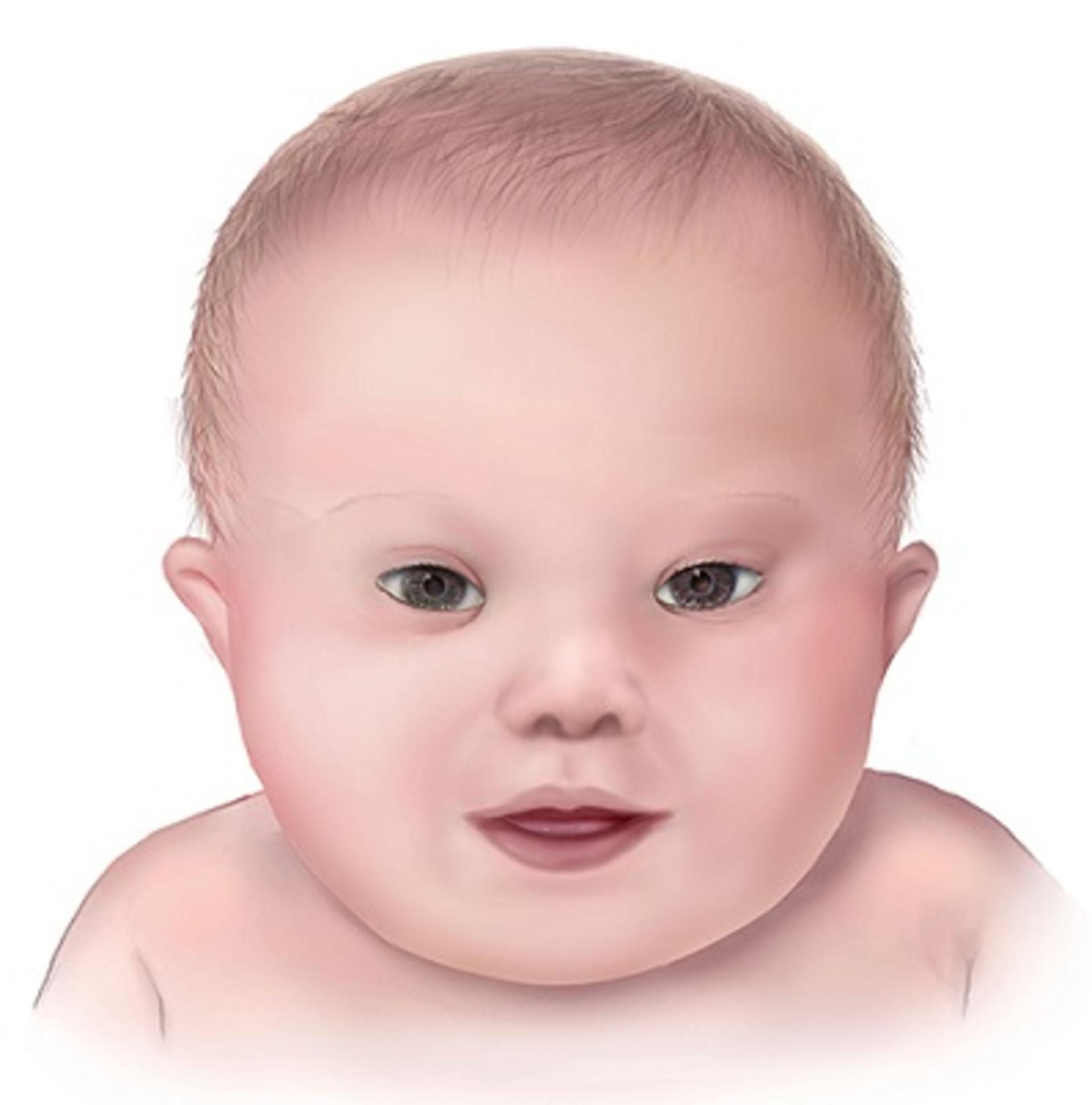 سندرم داون