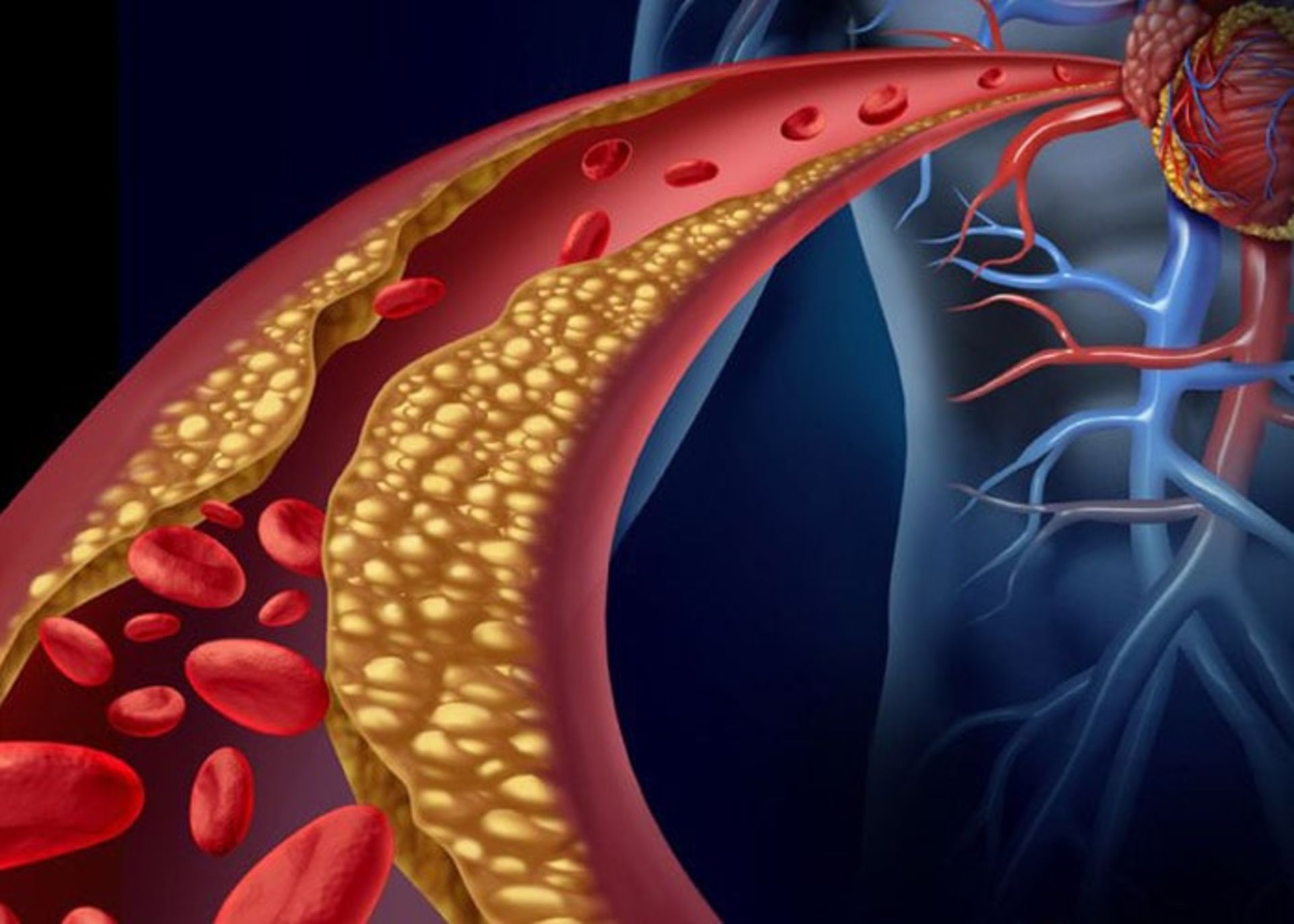 گرفتگی سرخرگ ها