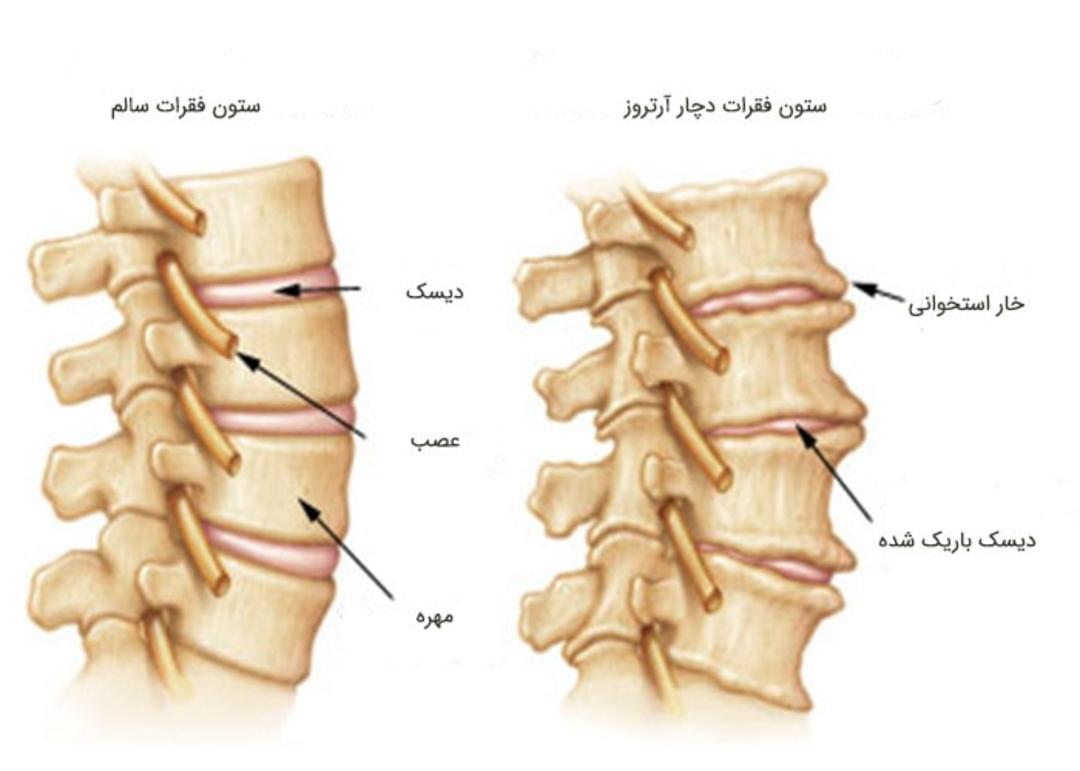 آرتروز ستون فقرات