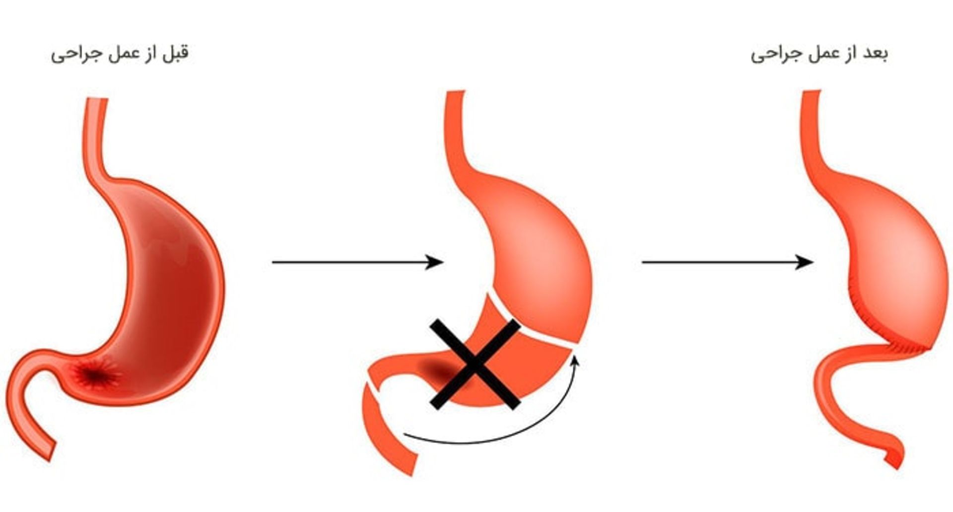 جراحی معده جزئی