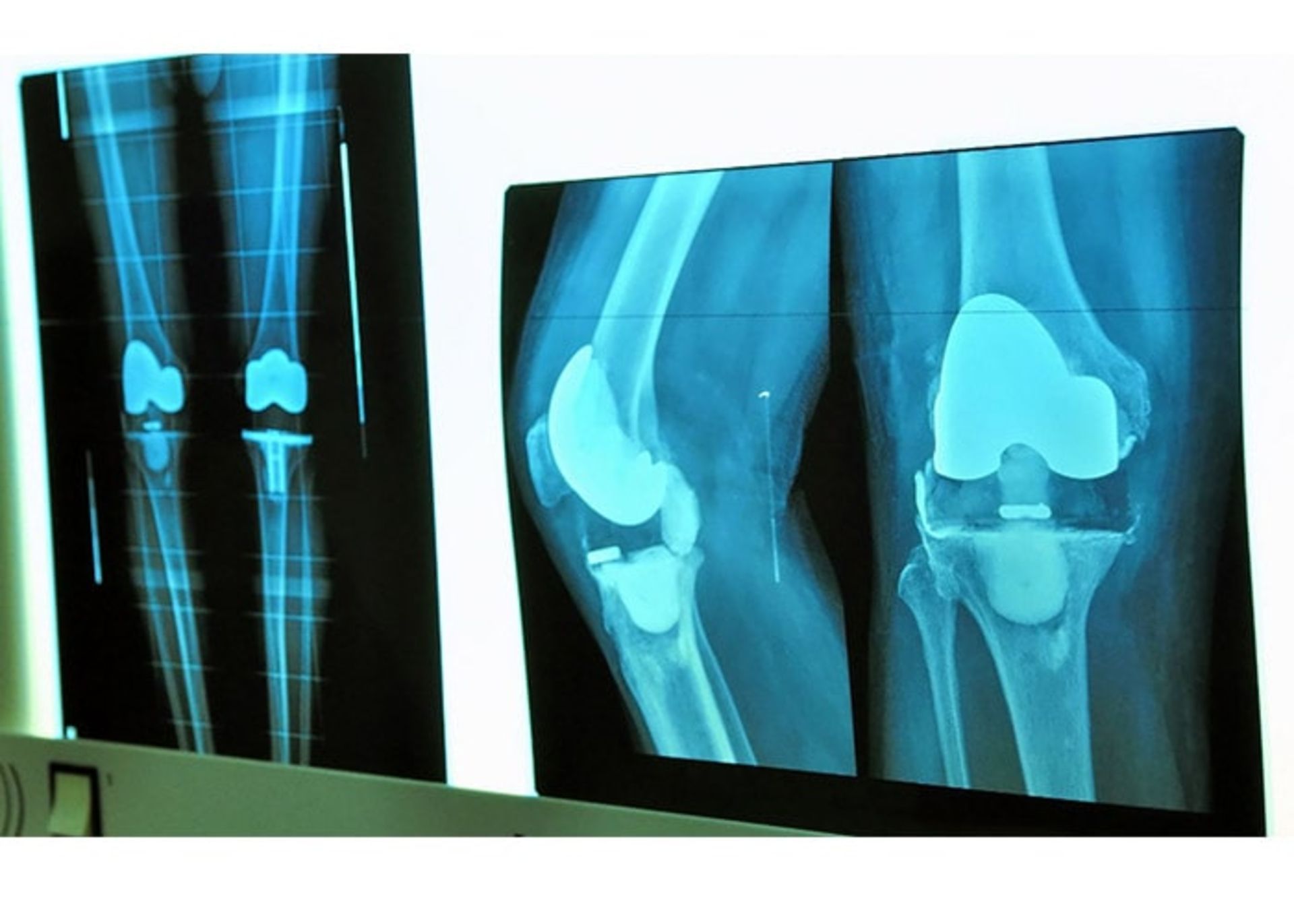 تشخیص آرتروز