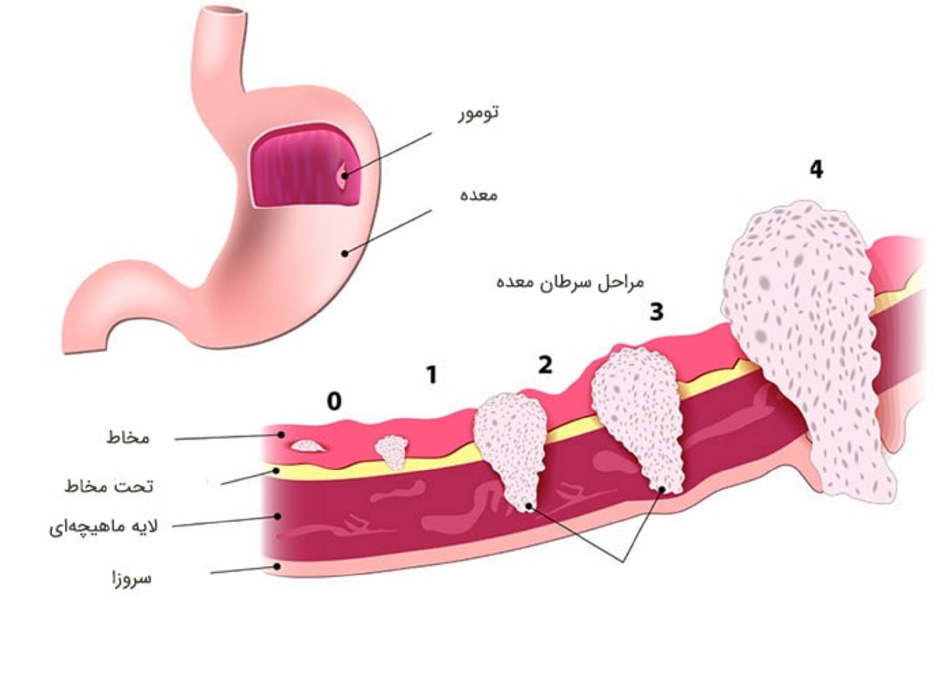 مراحل سرطان معده