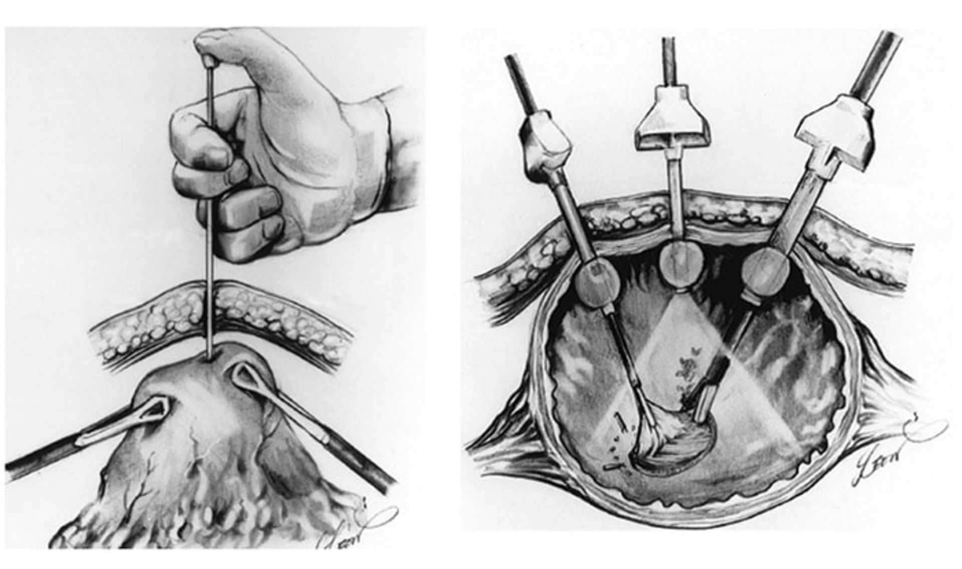 لاپاراسکوپی