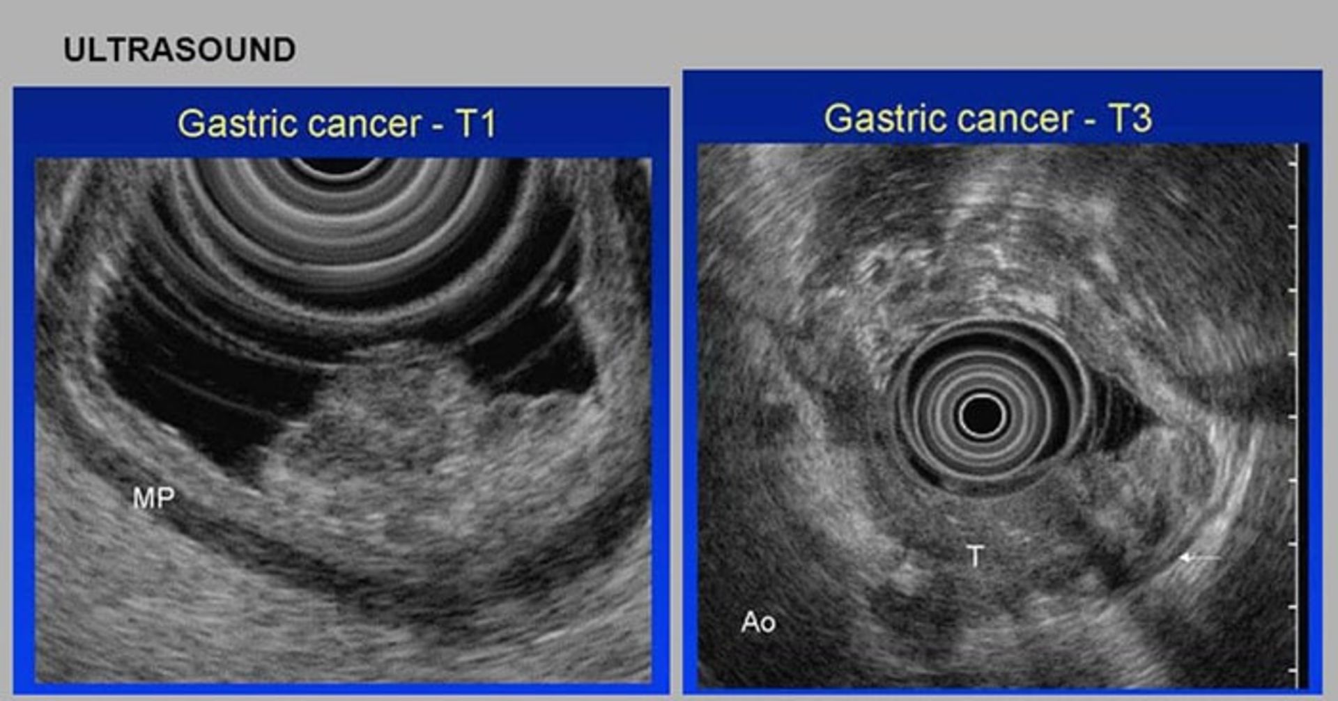 اولتراسوند برای تشخیص سرطان