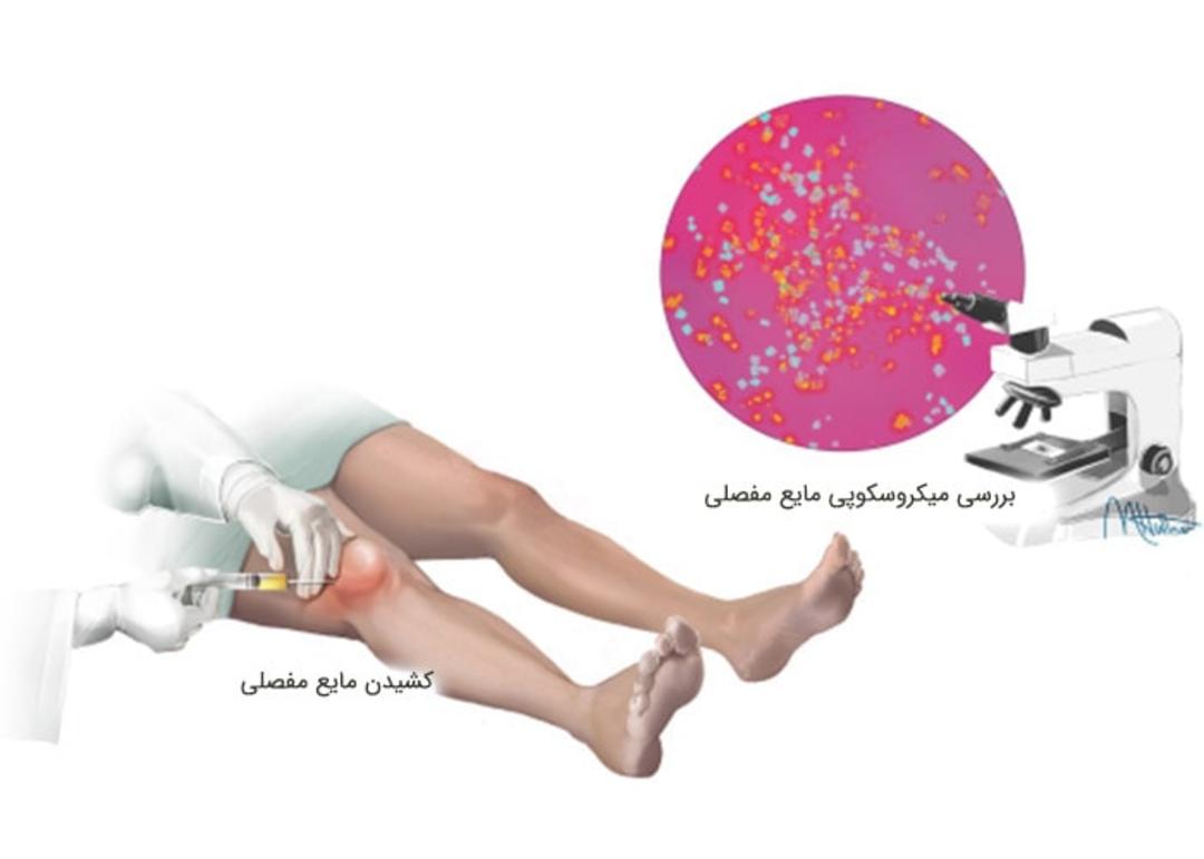 آزمایش مایع مفصلی