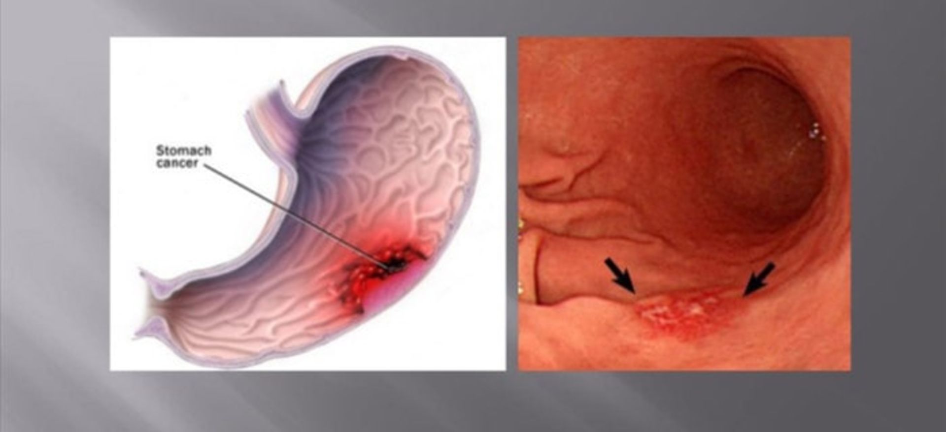 مصرف تنباکو و سرطان معده