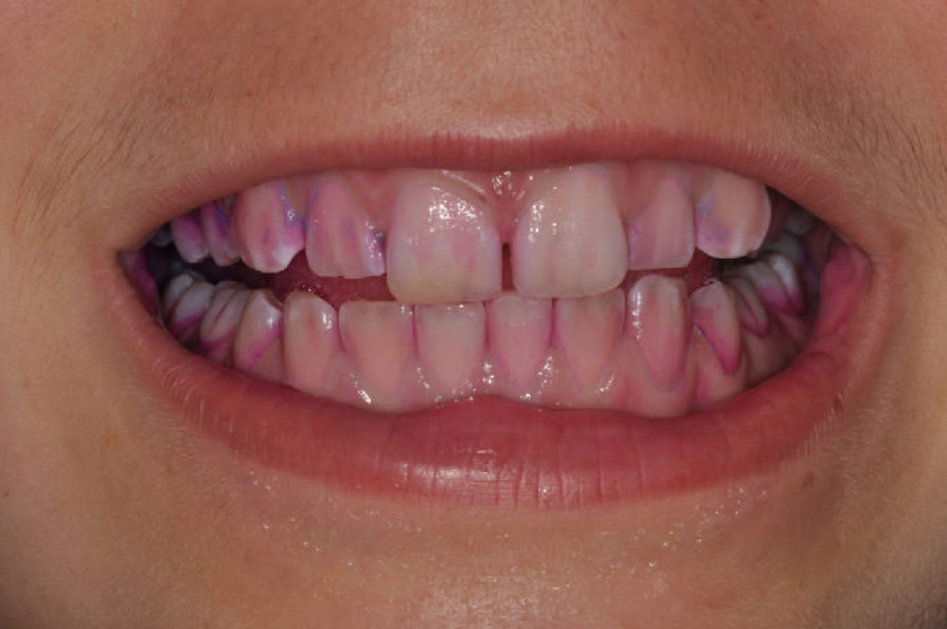 جرم دندان/ tooth plaque