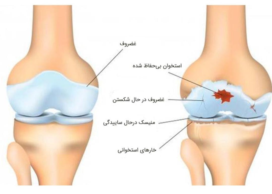 آرتروز