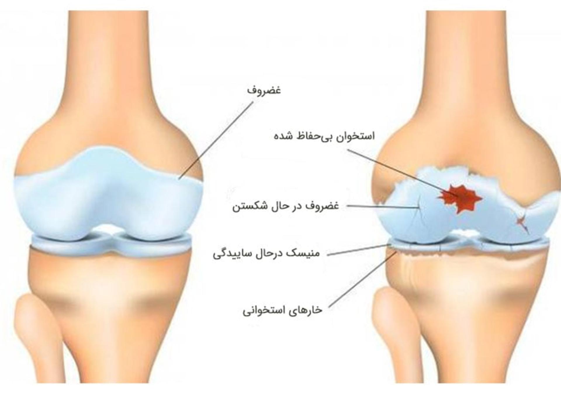 آرتروز
