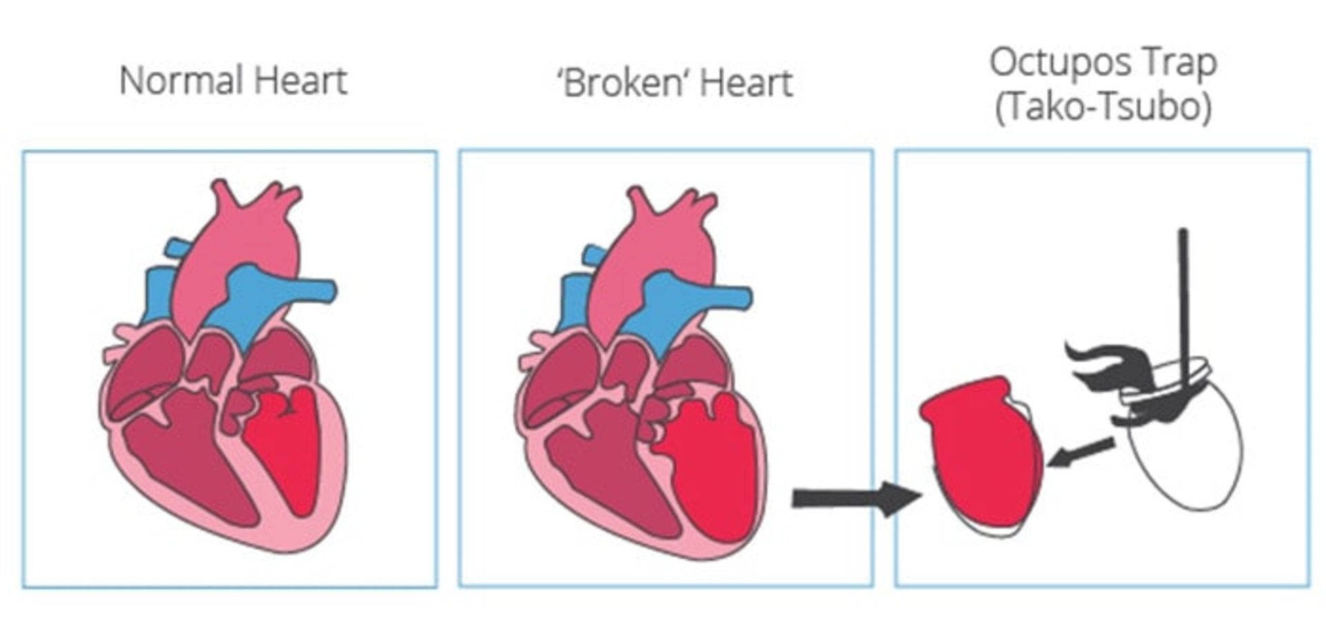 سندرم قلب شکسته