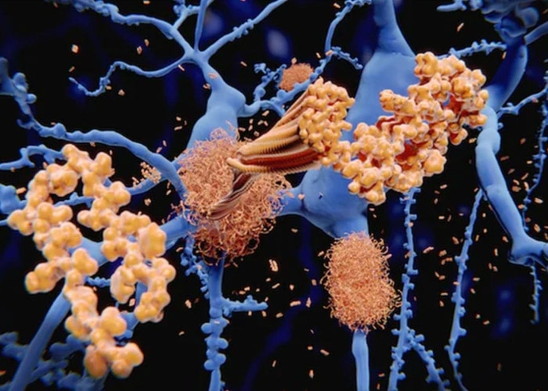 پلاک های آمیلوئید بتا