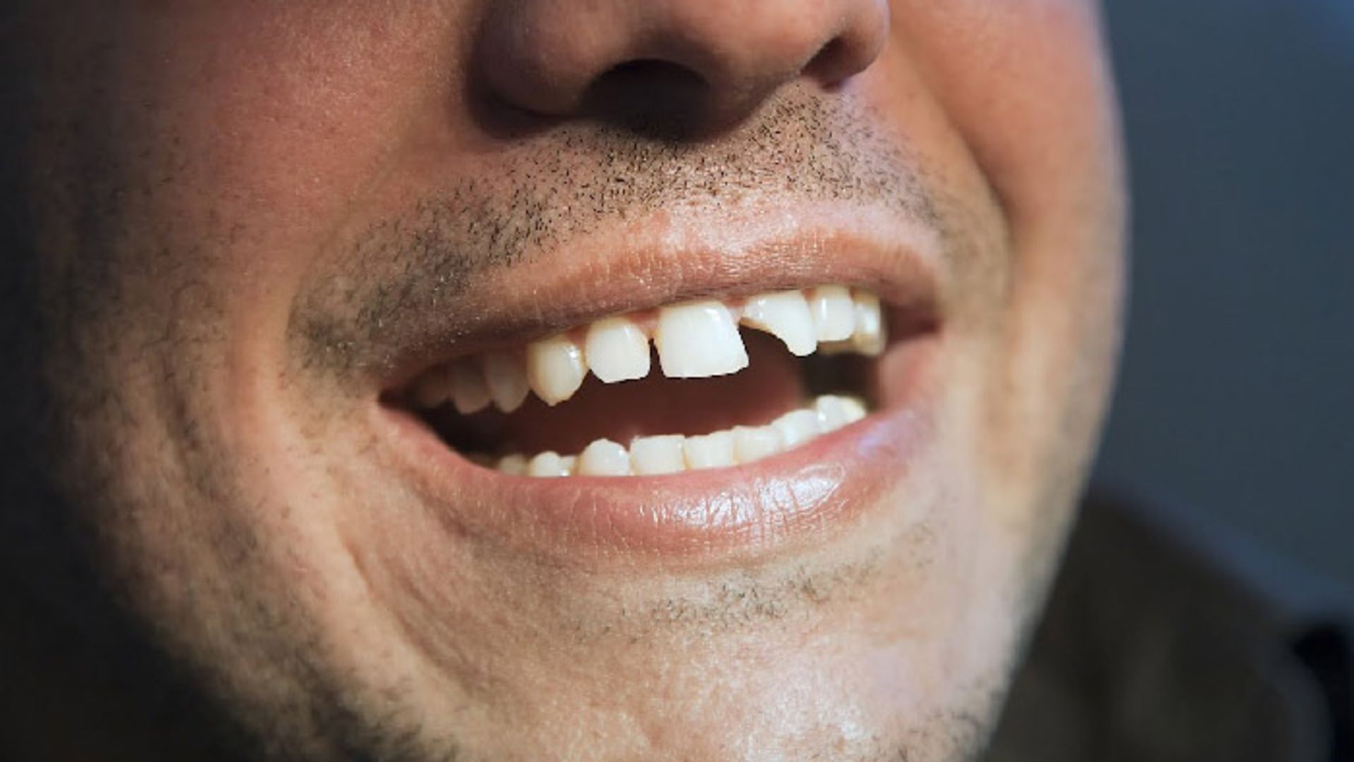 نامرتب بودن دندان ها