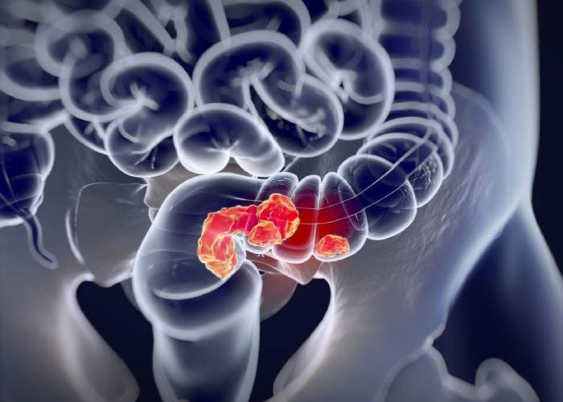 سرطان روده بزرگ