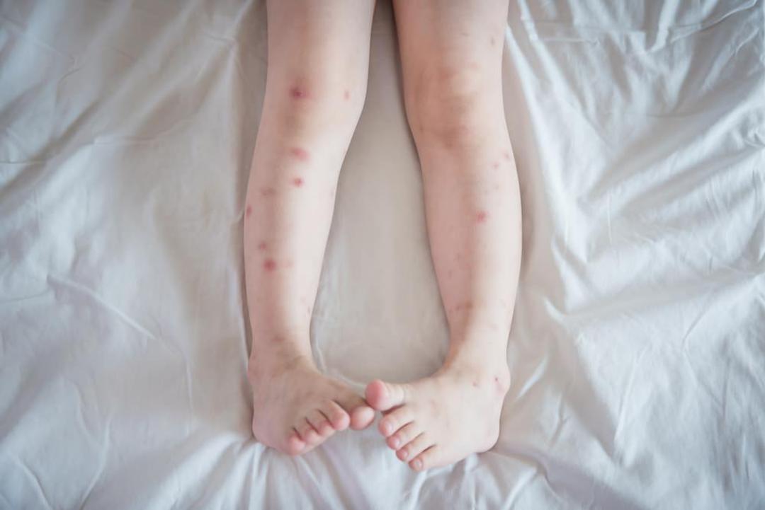 bed bug bites