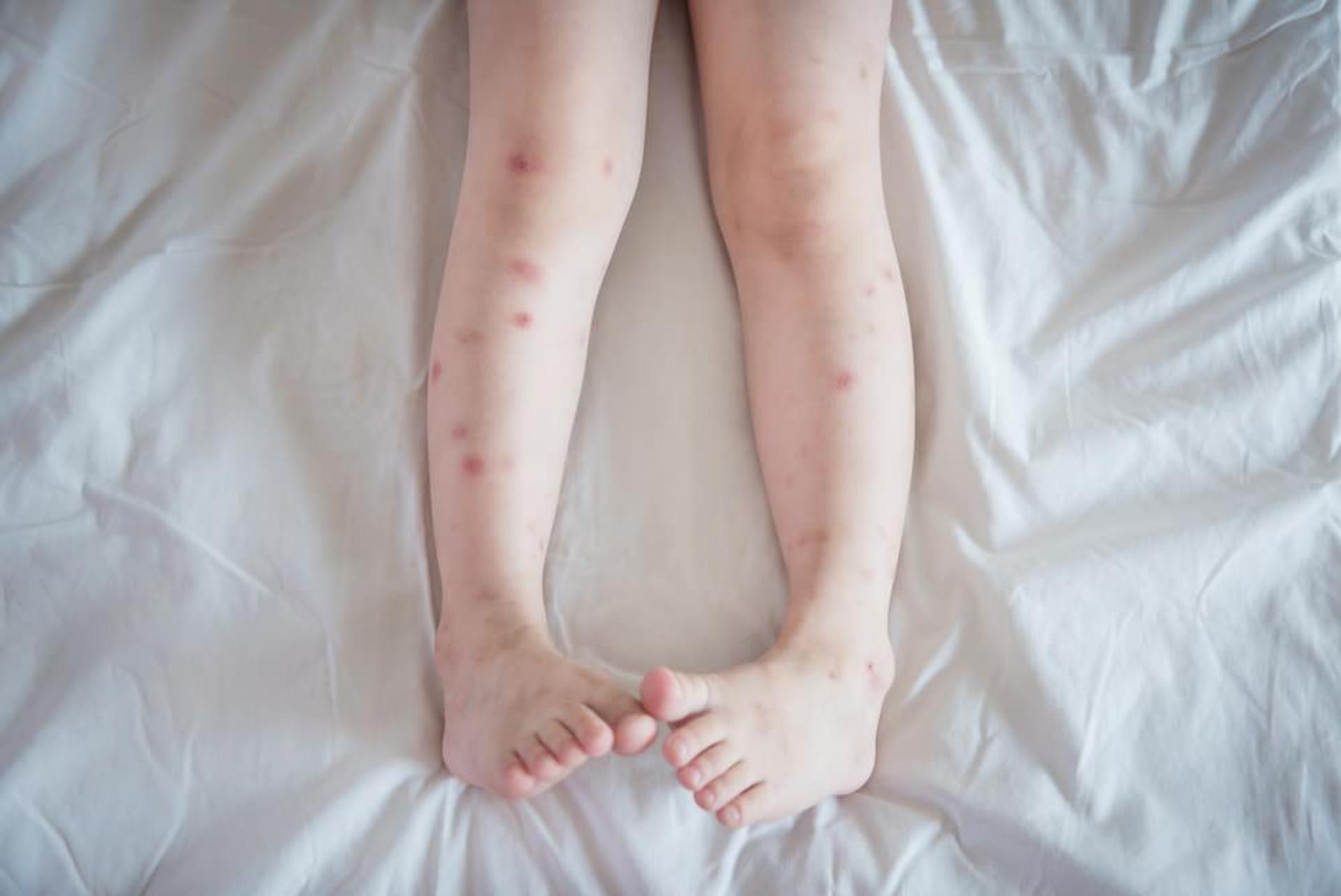 bed bug bites