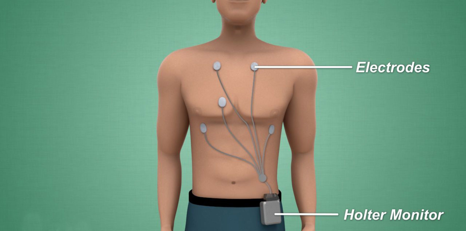 Holter monitoring