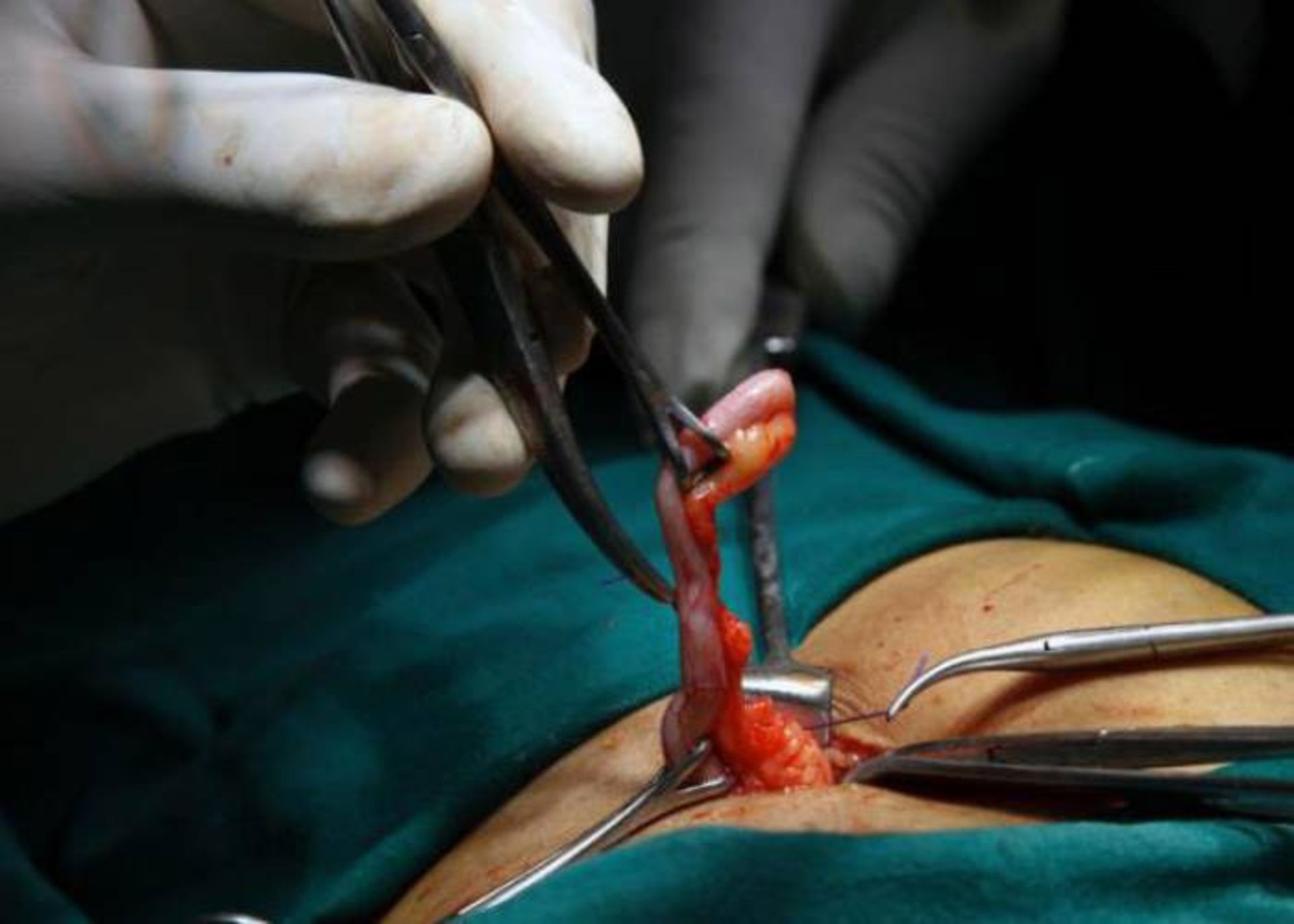 جراحی برداشت آپاندیس