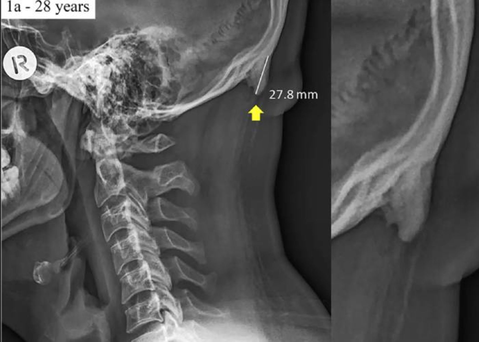 برجستگی پس سری