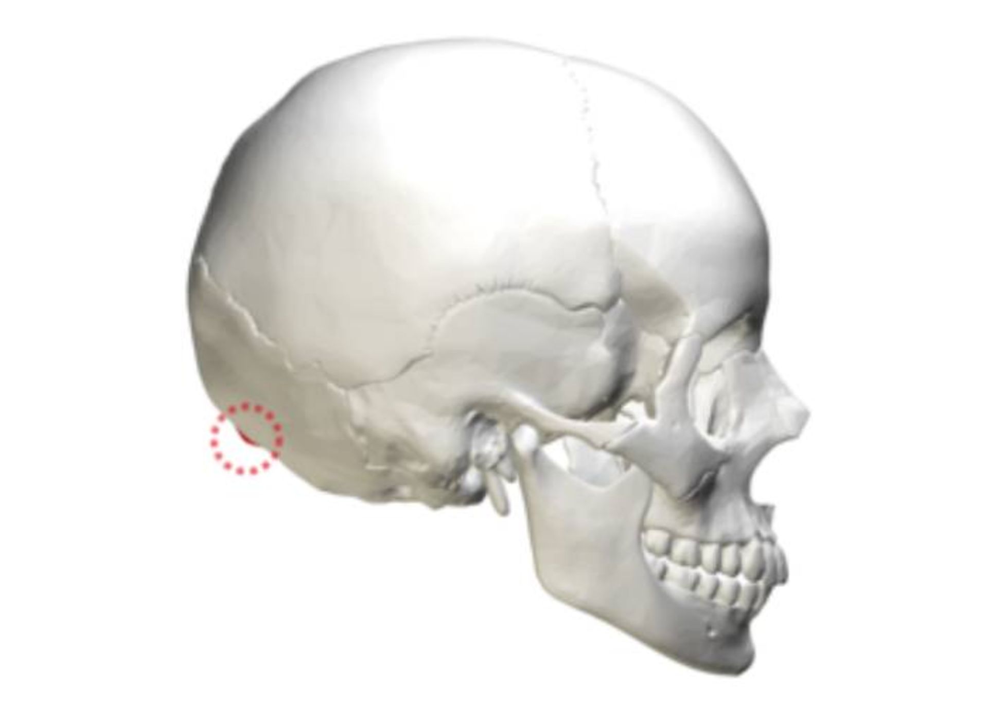 زائده استخوانی پس سری