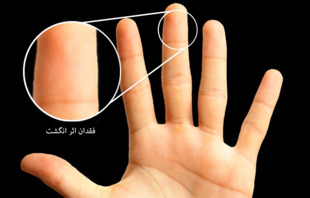 فقدان اثر انگشت