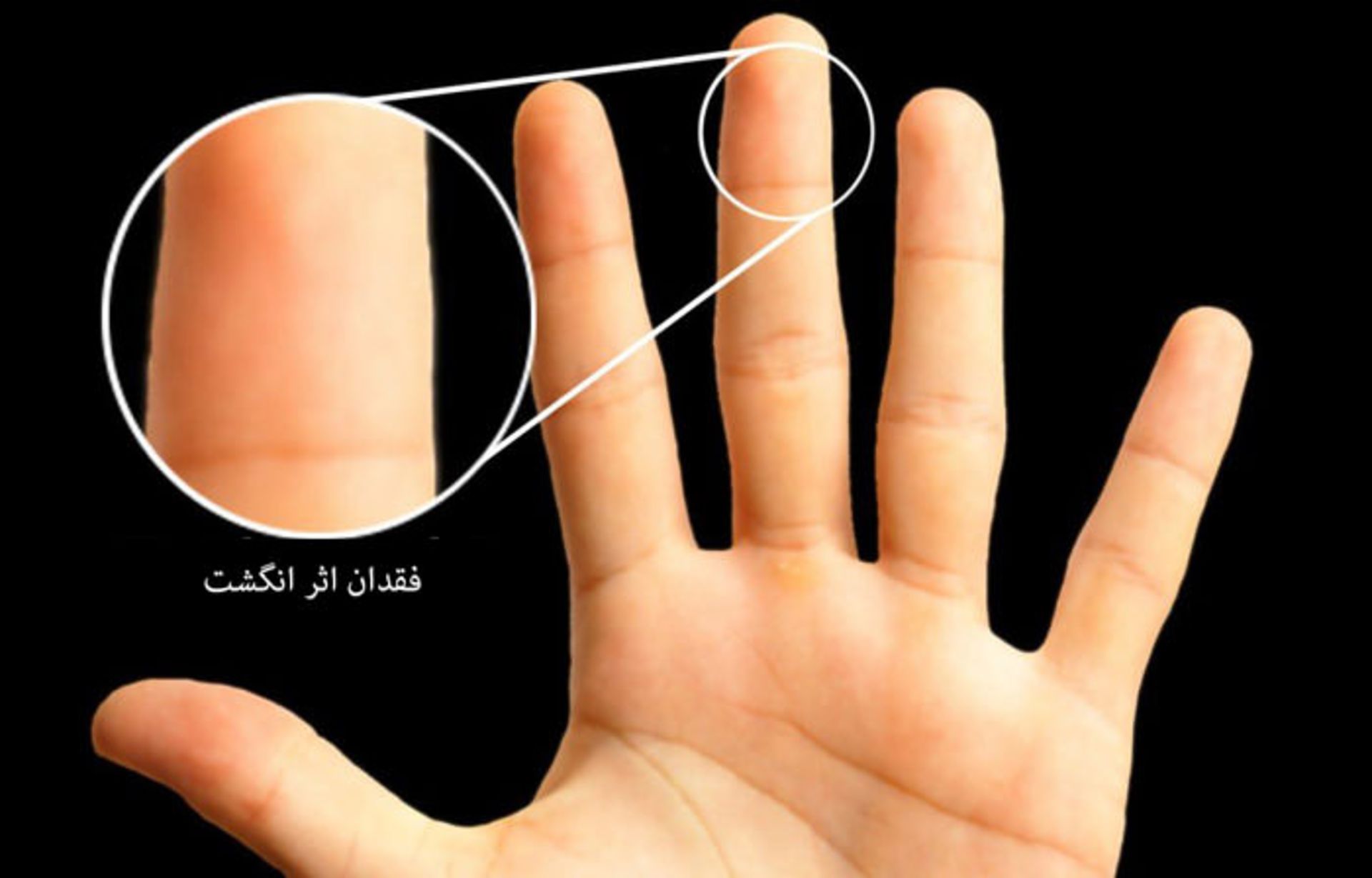 فقدان اثر انگشت