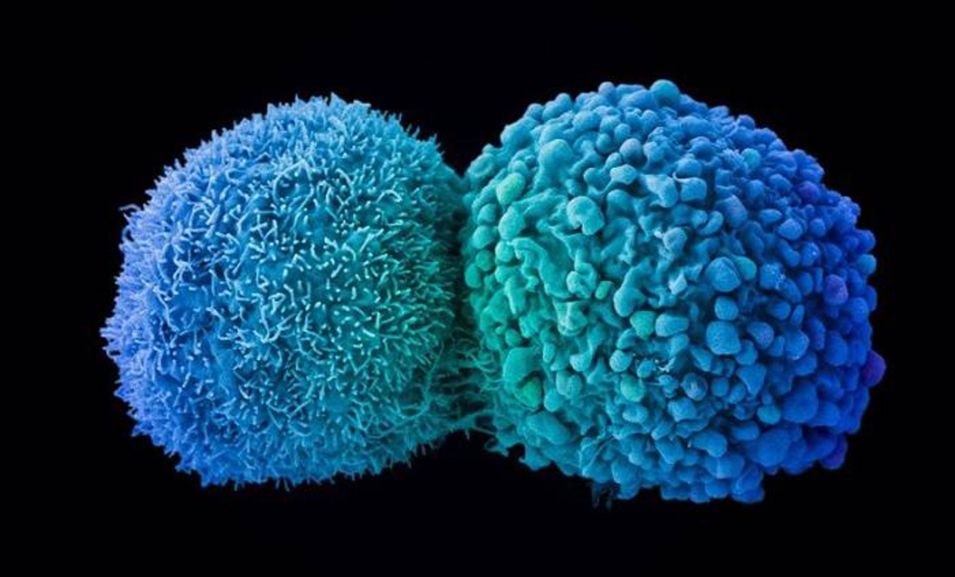 سلول سرطانی