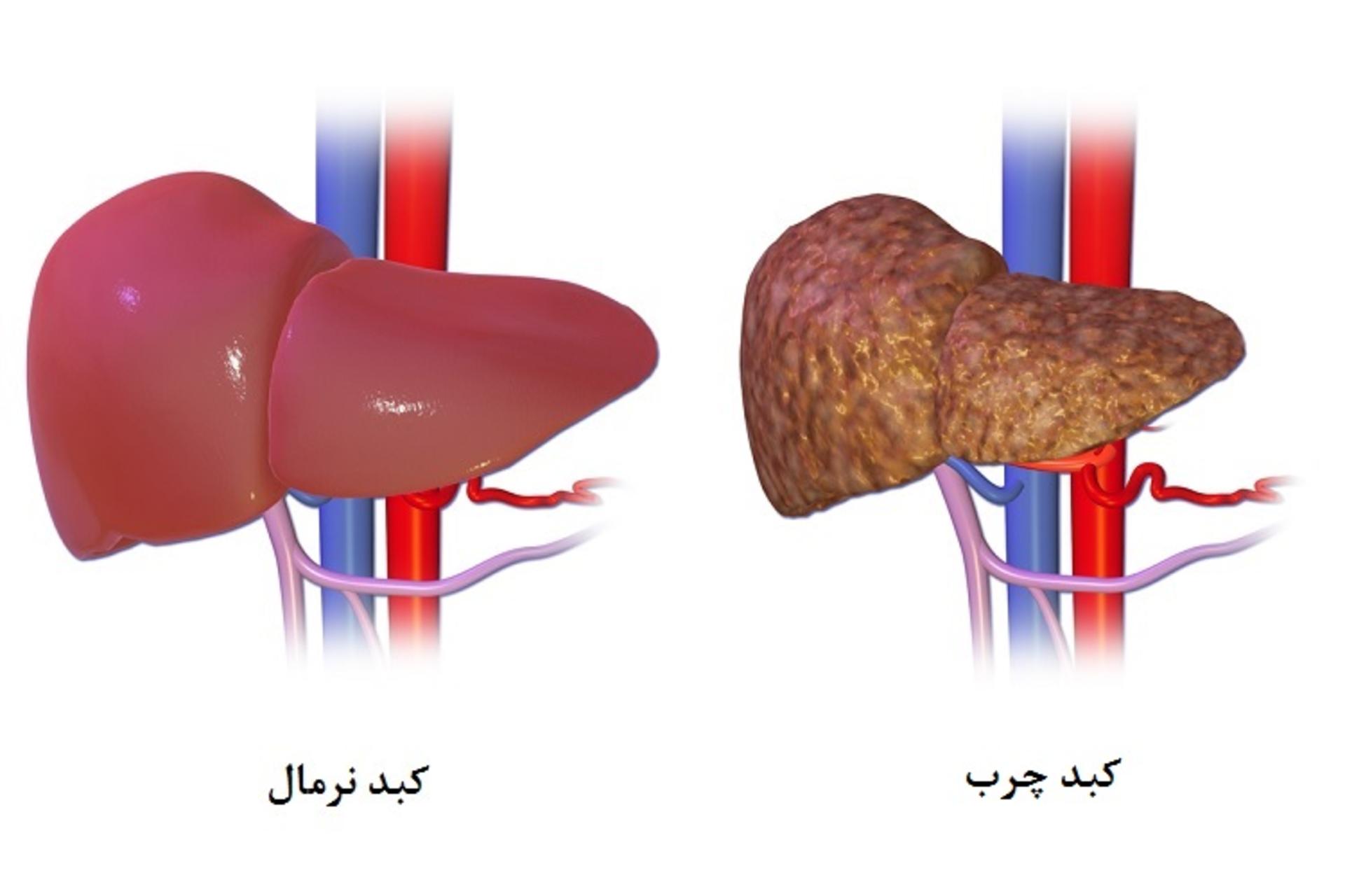 کبد چرب