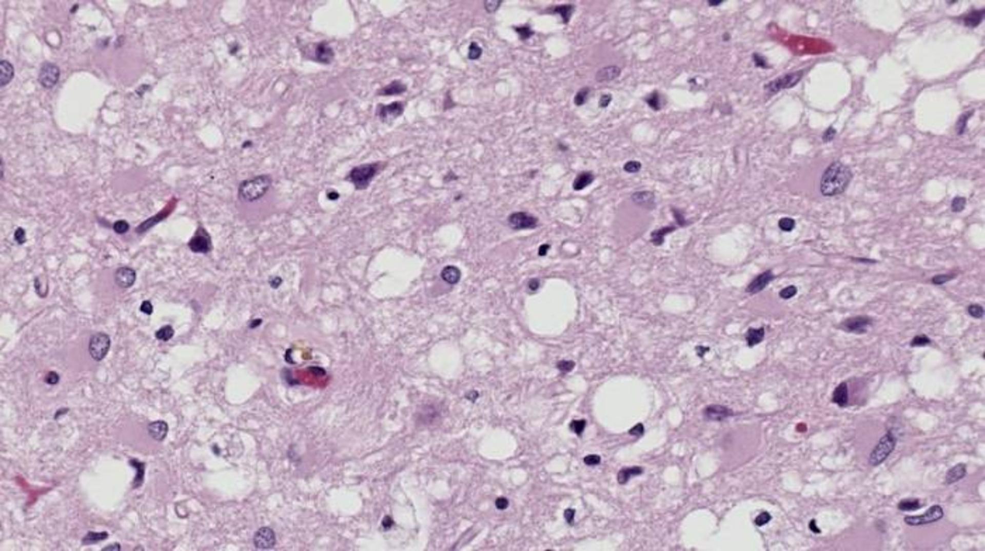 تاثیر بیماری‌ کروتزفلد یاکوب  روی مغز / Creutzfeldt-Jakob disease