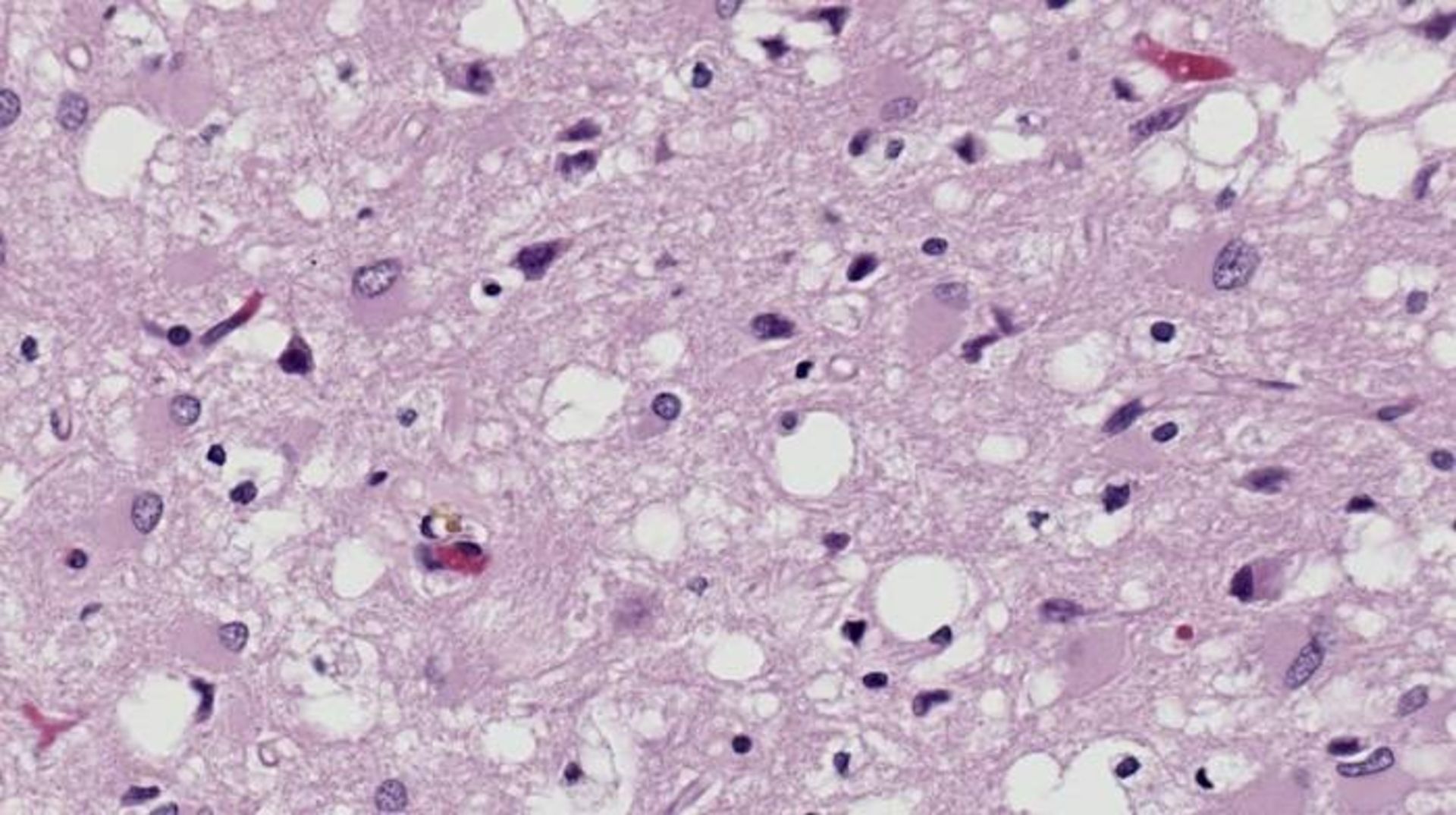 تاثیر بیماری‌ کروتزفلد یاکوب  روی مغز / Creutzfeldt-Jakob disease