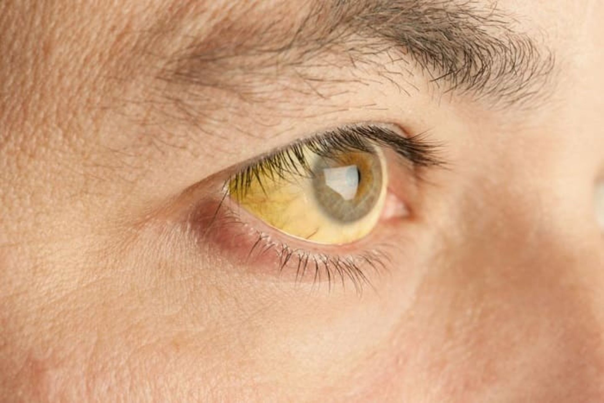 زردی چشم ناشی از تالاسمی