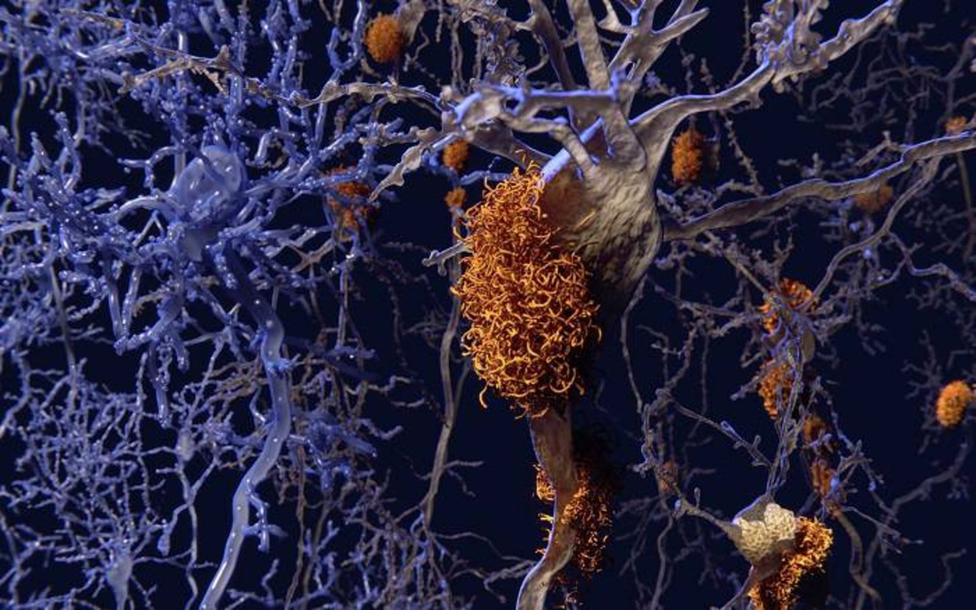 مغز در آلزایمر