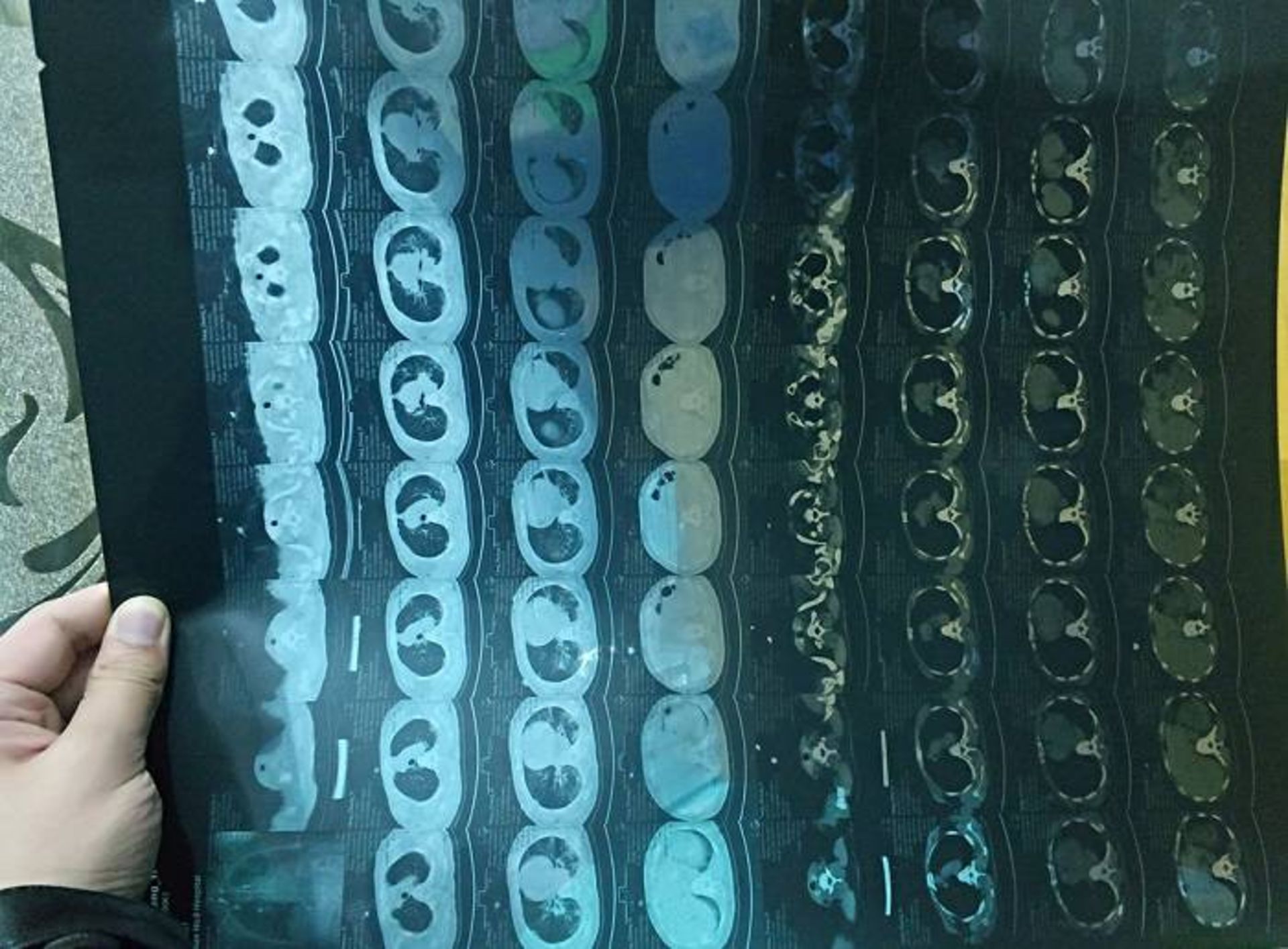 سی تی اسکن ریه بیمار کرونا