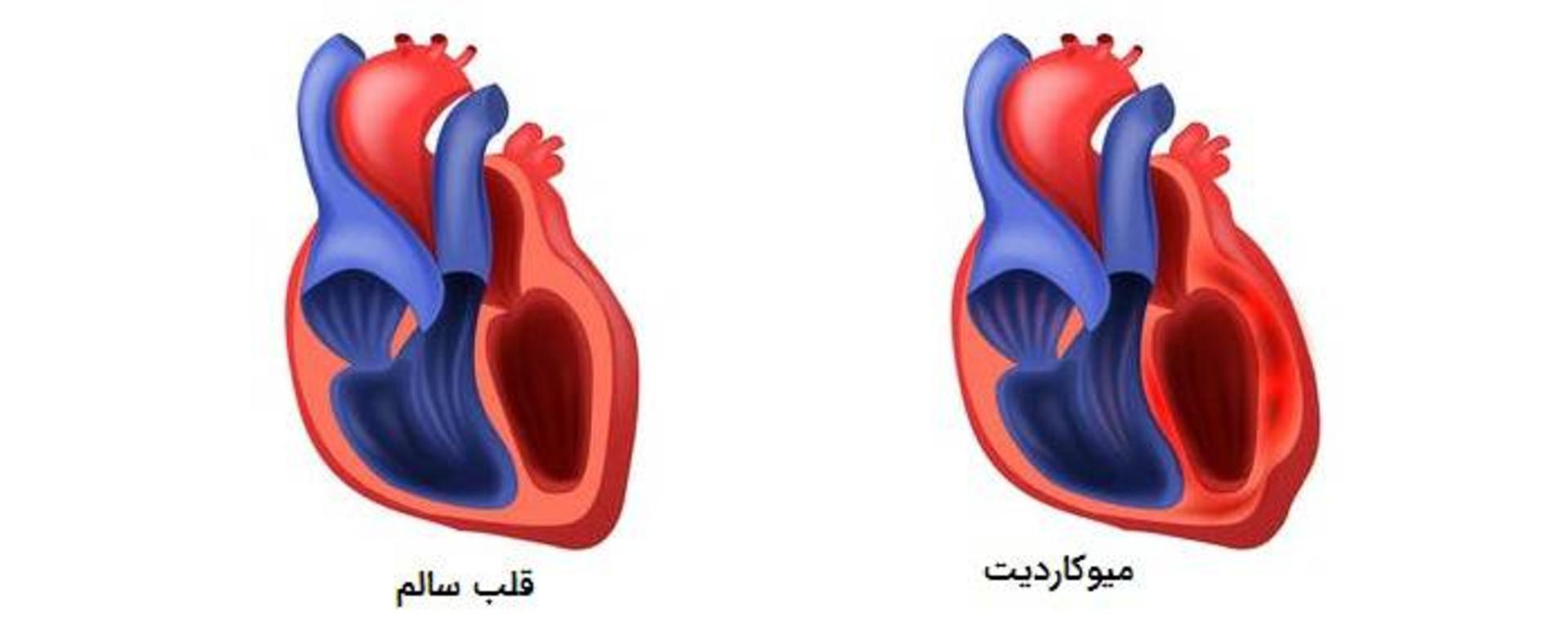 میوکاردیت